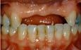 Những nguyên nhân dẫn đến nhổ răng